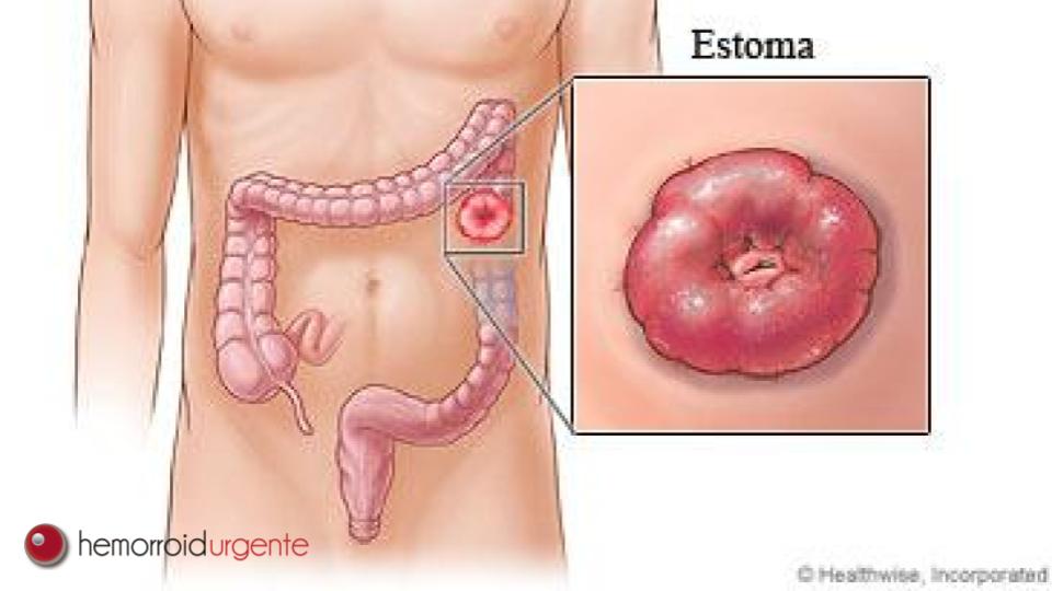 ostomia