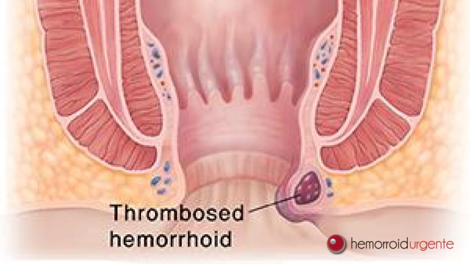 Hemorroida trombosada