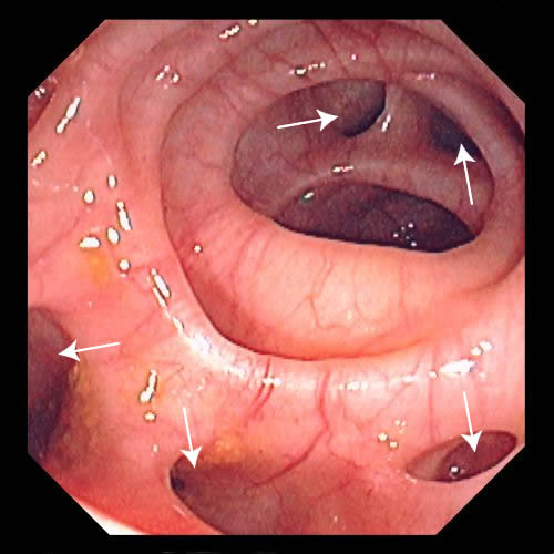 diverticulose